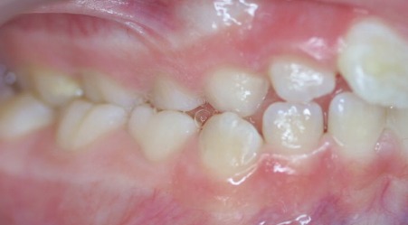 posterior crossbite